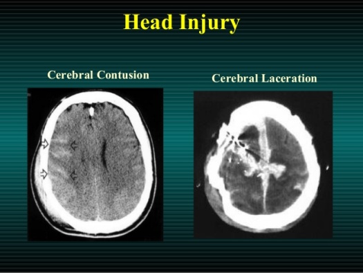 head-injury-types-clinical-manifestations-diagnosis-and-management-18-638