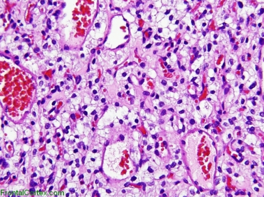 hemangioblastoma-2
