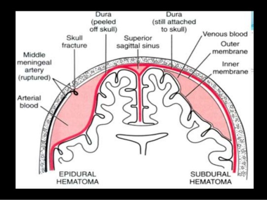 intracranial-hemorrhage-shruthi-s-jayaraj-calicut-medical-college-4-638