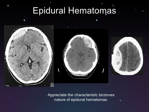 subdural-and-epidural-hematomas-6-728