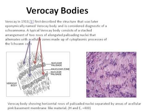 verocay-body